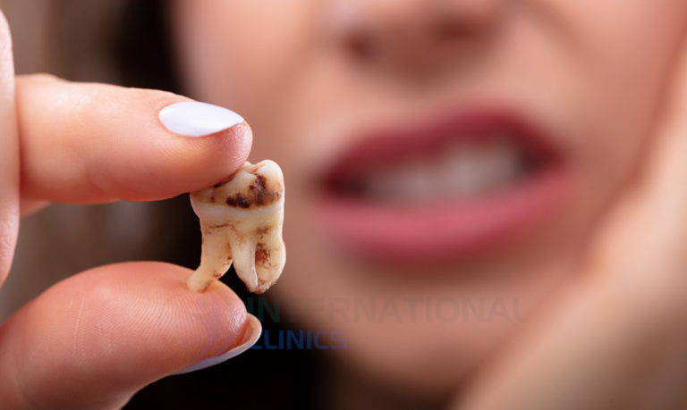 ما هي مراحل تسوس الأسنان؟